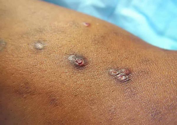 Bệnh nhiễm nấm Cryptococcus - Triệu chứng, nguyên nhân và cách điều trị