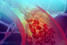 Thuốc Niceritrol - Điều trị bệnh tăng lipid máu