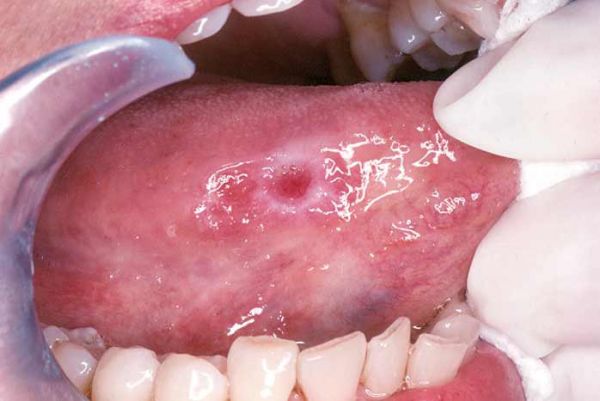 Bệnh ung thư lưỡi - Triệu chứng, nguyên nhân và cách điều trị