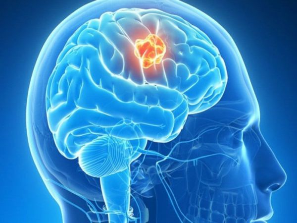 Bệnh ung thư não - Triệu chứng, nguyên nhân và cách điều trị