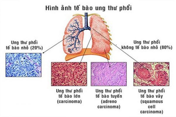 Bệnh ung thư phổi tế bào nhỏ - Triệu chứng, nguyên nhân và cách điều trị