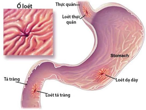 Bệnh ung thư tá tràng - Triệu chứng, nguyên nhân và cách điều trị