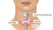 Bệnh ung thư tuyến cận giáp - Triệu chứng, nguyên nhân và cách điều trị