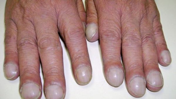 Bệnh ngón tay dùi trống - Triệu chứng, nguyên nhân và cách điều trị