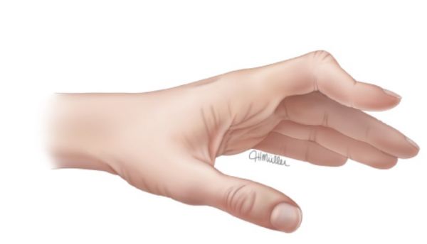 Bệnh ngón tay vồ - Triệu chứng, nguyên nhân và cách điều trị