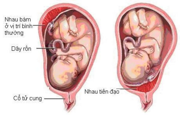 Bệnh nhau tiền đạo - Triệu chứng, nguyên nhân và cách điều trị