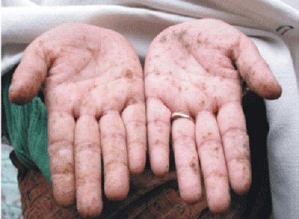 Bệnh nhiễm độc chì - Triệu chứng, nguyên nhân và cách điều trị