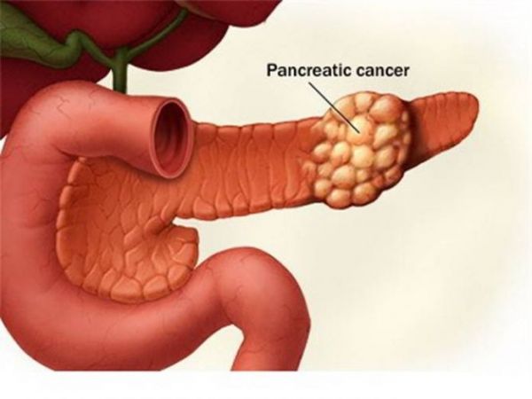 Bệnh ung thư tuyến tụy - Triệu chứng, nguyên nhân và cách điều trị