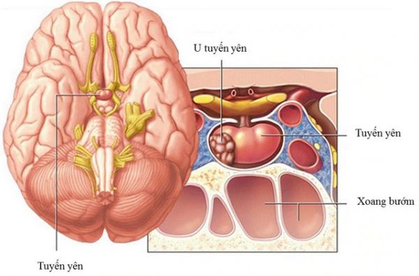 Bệnh ung thư tuyến yên - Triệu chứng, nguyên nhân và cách điều trị