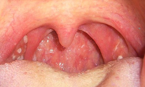 Bệnh ung thư vòm họng - Triệu chứng, nguyên nhân và cách điều trị