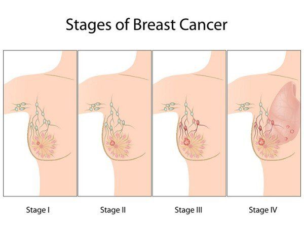 Bệnh ung thư vú - Triệu chứng, nguyên nhân và cách điều trị
