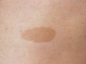 Vết bớt - Triệu chứng, nguyên nhân và cách điều trị