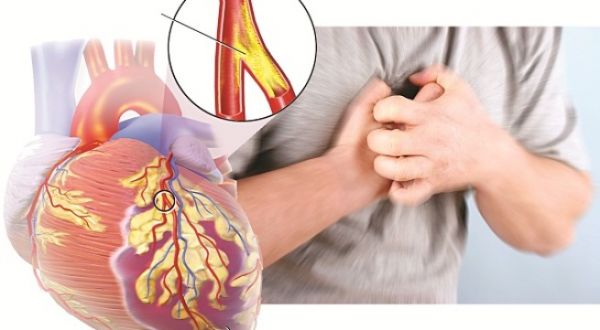 Bệnh bóc tách động mạch vành tự phát - Triệu chứng, nguyên nhân và cách điều trị