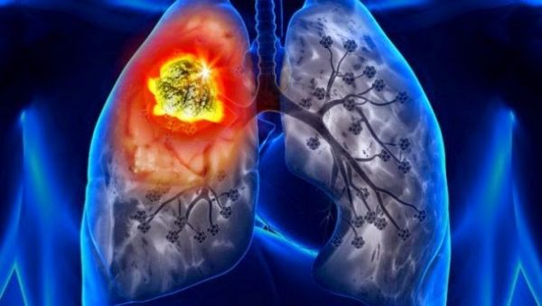 Bệnh bụi phổi amiăng - Triệu chứng, nguyên nhân và cách điều trị