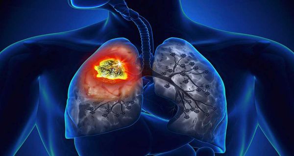 Bệnh bụi phổi - Triệu chứng, nguyên nhân và cách điều trị