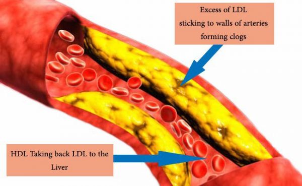 Bệnh LDL cholesterol - Triệu chứng, nguyên nhân và cách điều trị