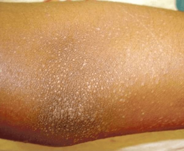 Bệnh Lichen nitidus - Triệu chứng, nguyên nhân và cách điều trị