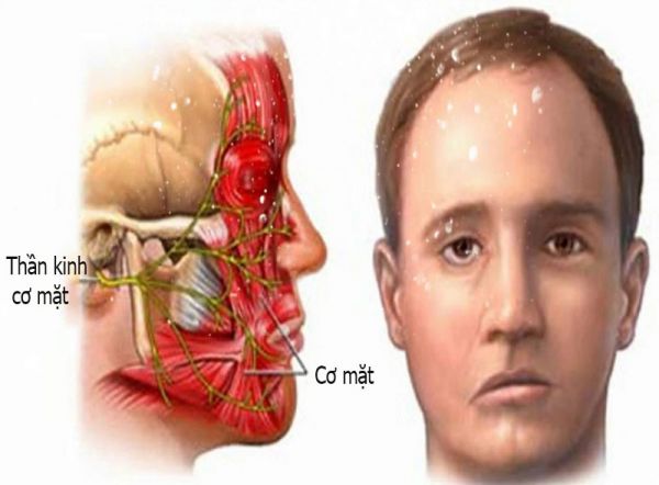 Bệnh liệt Bell - Triệu chứng, nguyên nhân và cách điều trị