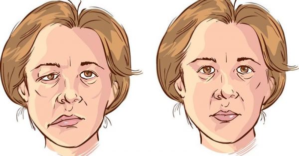 Hội chứng liệt mặt - Triệu chứng, nguyên nhân và cách điều trị
