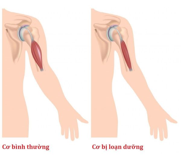 Bệnh loạn dưỡng cơ - Triệu chứng, nguyên nhân và cách điều trị