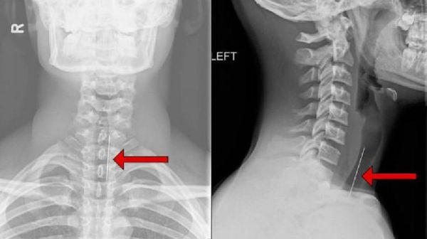 Thủ thuật X-quang cột sống cổ - Quy trình thực hiện và những lưu ý cần biết