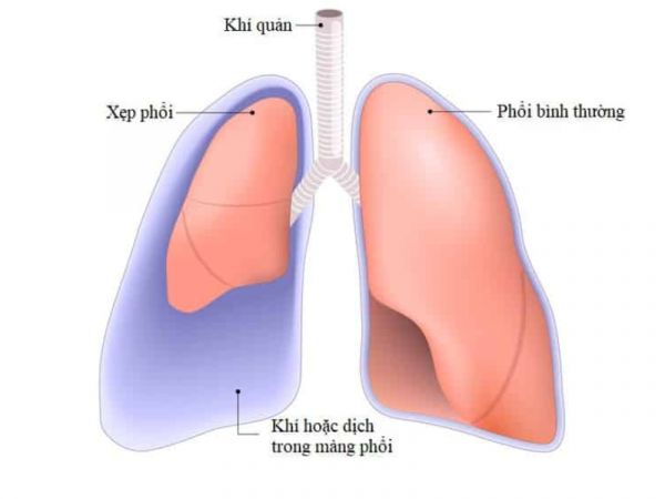 Bệnh xẹp phổi - Triệu chứng, nguyên nhân và cách điều trị