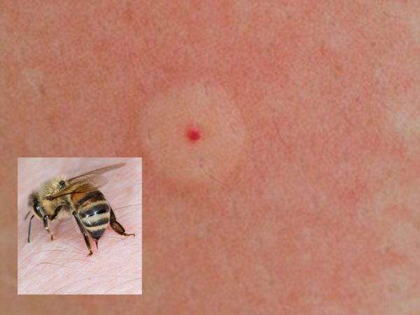 Vết ong chích - Triệu chứng, nguyên nhân và cách điều trị