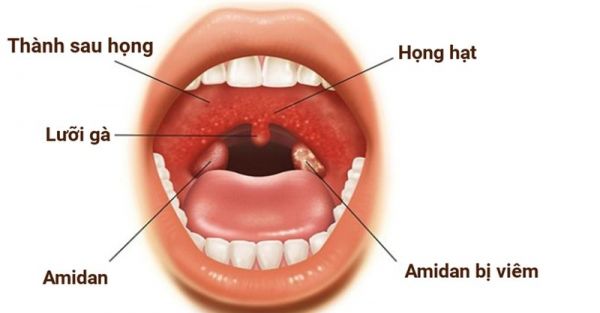 Bệnh viêm bạch huyết vòm họng - Triệu chứng, nguyên nhân và cách điều trị