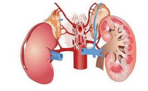 Bệnh viêm cầu thận mạn tính - Triệu chứng, nguyên nhân và cách điều trị