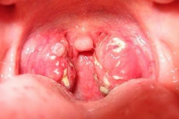 Bệnh viêm họng do liên cầu khuẩn - Triệu chứng, nguyên nhân và cách điều trị