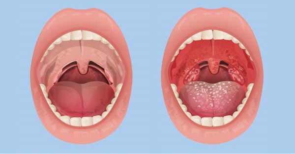 Bệnh viêm họng - Triệu chứng, nguyên nhân và cách điều trị