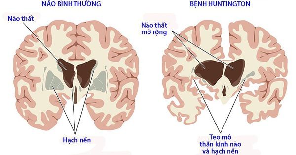 Bệnh Huntington - Triệu chứng, nguyên nhân và cách điều trị