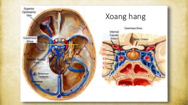 Bệnh huyết khối xoang hang - Triệu chứng, nguyên nhân và cách điều trị