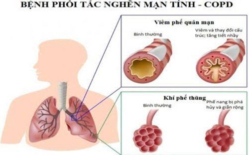 Khám thực thể bệnh tắc nghẽn phổi mãn tính COPD - Quy trình thực hiện và những lưu ý