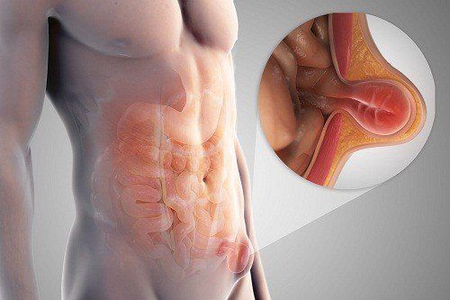 Bệnh khiếm khuyết cơ thành bụng - Triệu chứng, nguyên nhân và cách điều trị