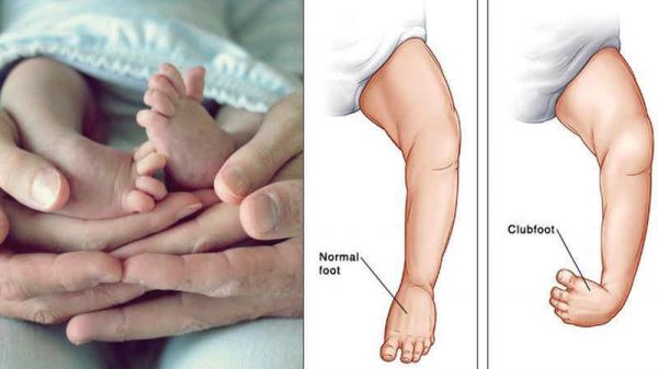 Khoèo chân bẩm sinh - Triệu chứng, nguyên nhân và cách điều trị