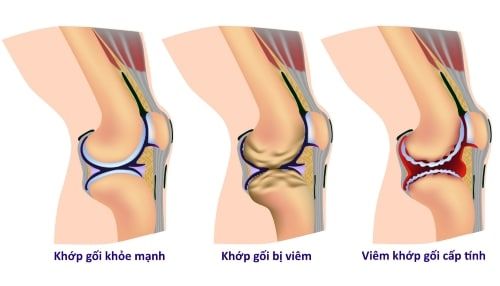 Bệnh viêm khớp gối - Triệu chứng, nguyên nhân và cách điều trị