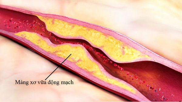 Bệnh xơ cứng động mạch - Triệu chứng, nguyên nhân và cách điều trị