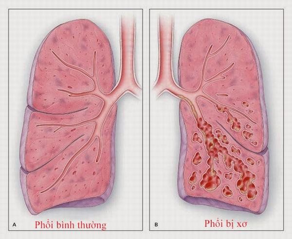 Bệnh xơ phổi - Triệu chứng, nguyên nhân và cách điều trị