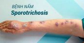 Bệnh nấm Sporotrichosis - Triệu chứng, nguyên nhân và cách điều trị