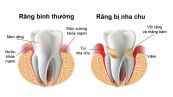 Bệnh nha chu - Triệu chứng, nguyên nhân và cách điều trị