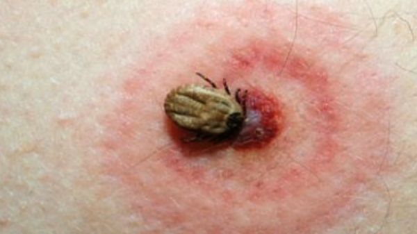 Bệnh Lyme - Triệu chứng, nguyên nhân và cách điều trị