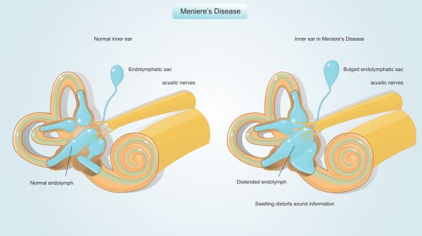Bệnh Meniere - Triệu chứng, nguyên nhân và cách điều trị