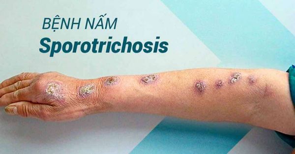 Bệnh nấm Sporotrichosis - Triệu chứng, nguyên nhân và cách điều trị
