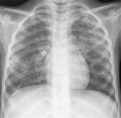 Bệnh lao kê - Triệu chứng, nguyên nhân và cách điều trị