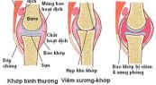 Bệnh viêm khớp nhiễm trùng sinh mủ - Triệu chứng, nguyên nhân và cách điều trị