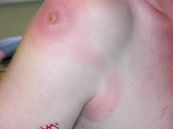 Bệnh viêm mạch bạch huyết - Triệu chứng, nguyên nhân và cách điều trị