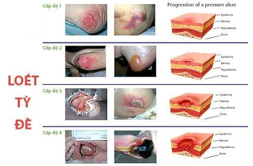 Bệnh loét do tì đè - Triệu chứng, nguyên nhân và cách điều trị