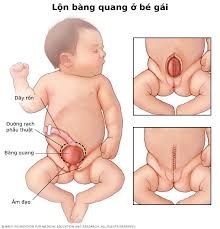 Bệnh lộn bàng quang - Triệu chứng, nguyên nhân và cách điều trị