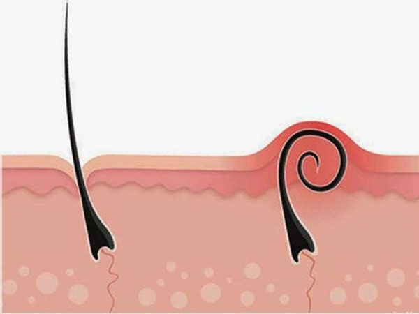 Bệnh lông mọc ngược - Triệu chứng, nguyên nhân và cách điều trị
